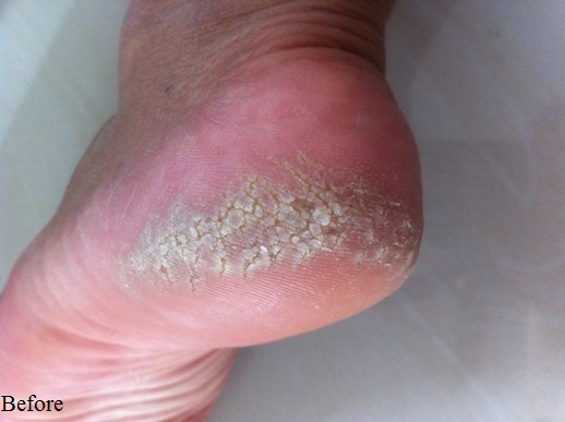 Description: Description: Foot Skin Problem-Before