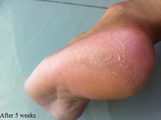 Description: Description: Foot Skin Problem-After 5 weeks